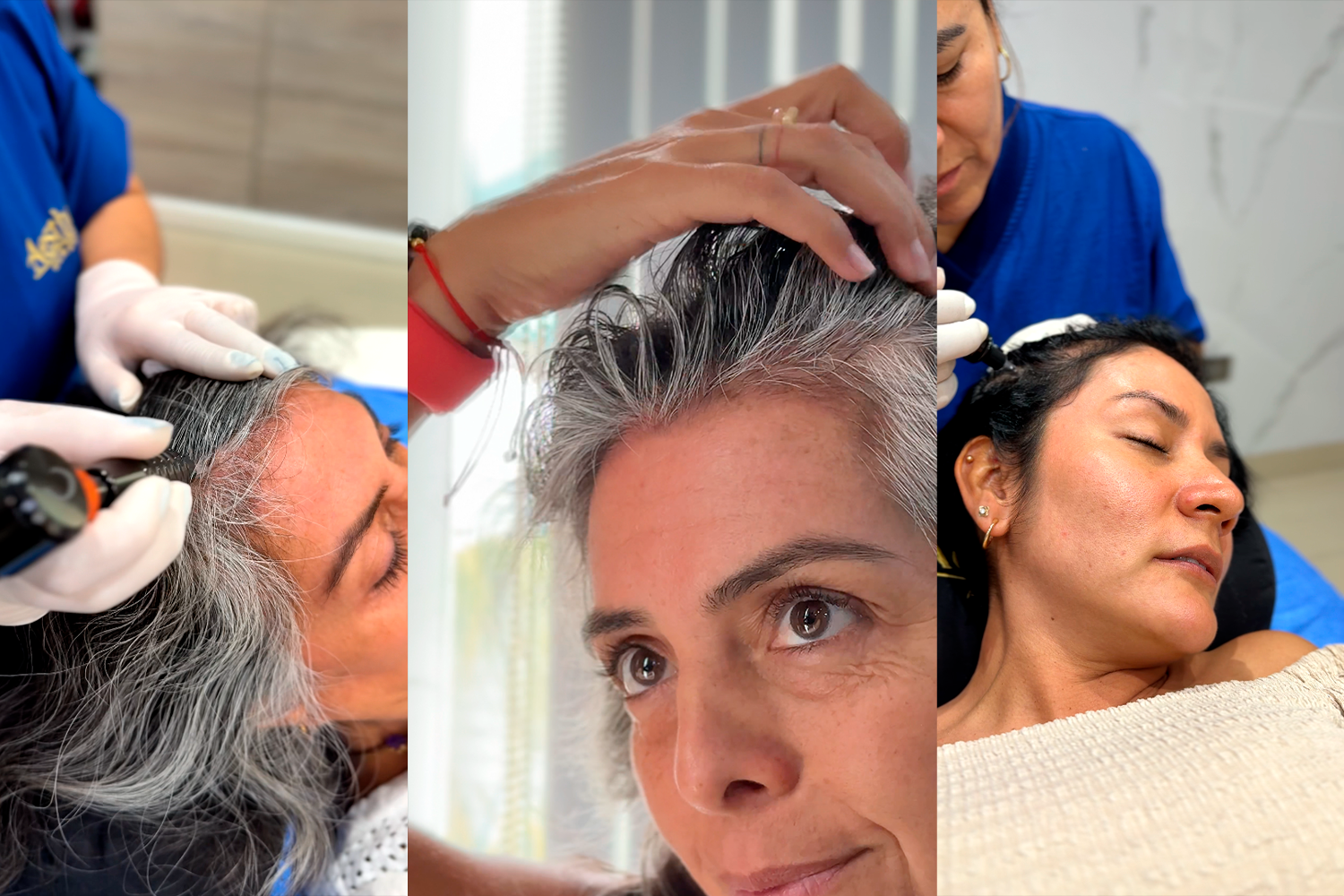 Alopecia Femenina: Cómo Afrontar la Pérdida de Cabello y Recuperar la Confianza