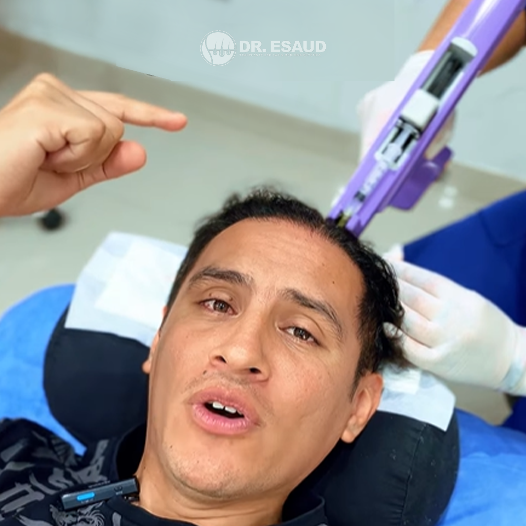 Gyofred Muñoz recibiendo su mesoterapia capilar en Dr. Esaud
