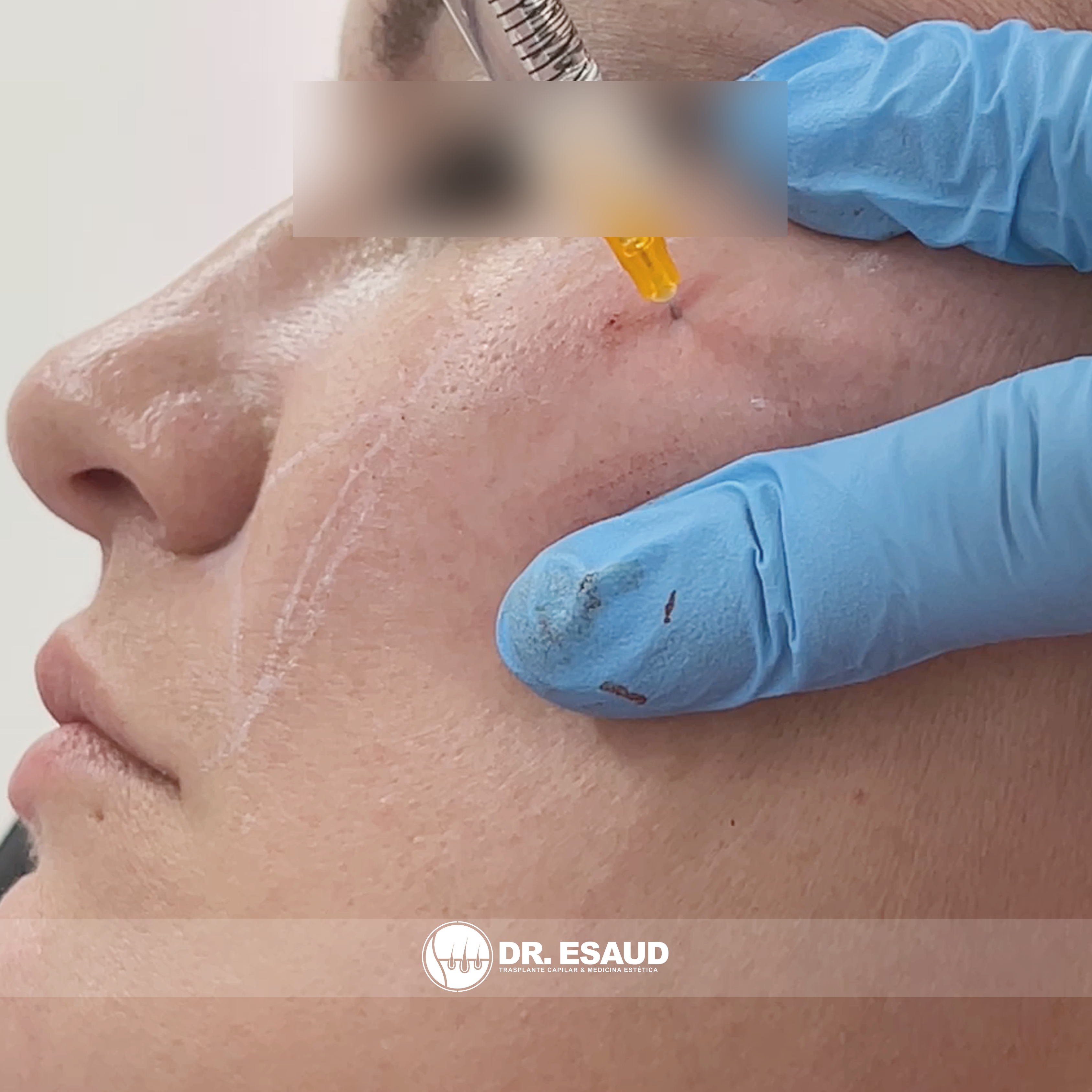 Aplicación de ácido hialurónico en pómulos por el Dr. Esaud