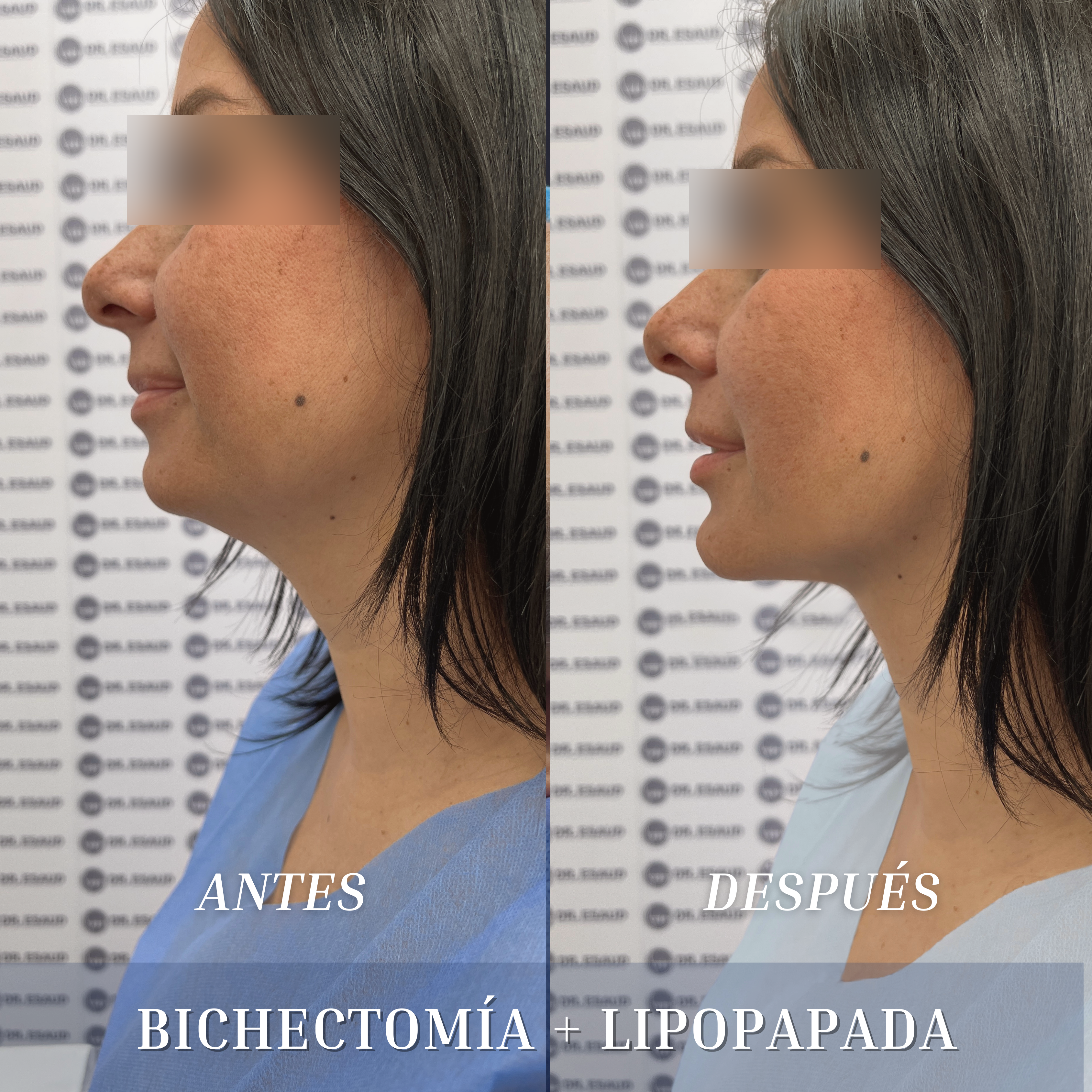 Resultado de una bichectomía más lipopapada realizada por el Dr. Esaud