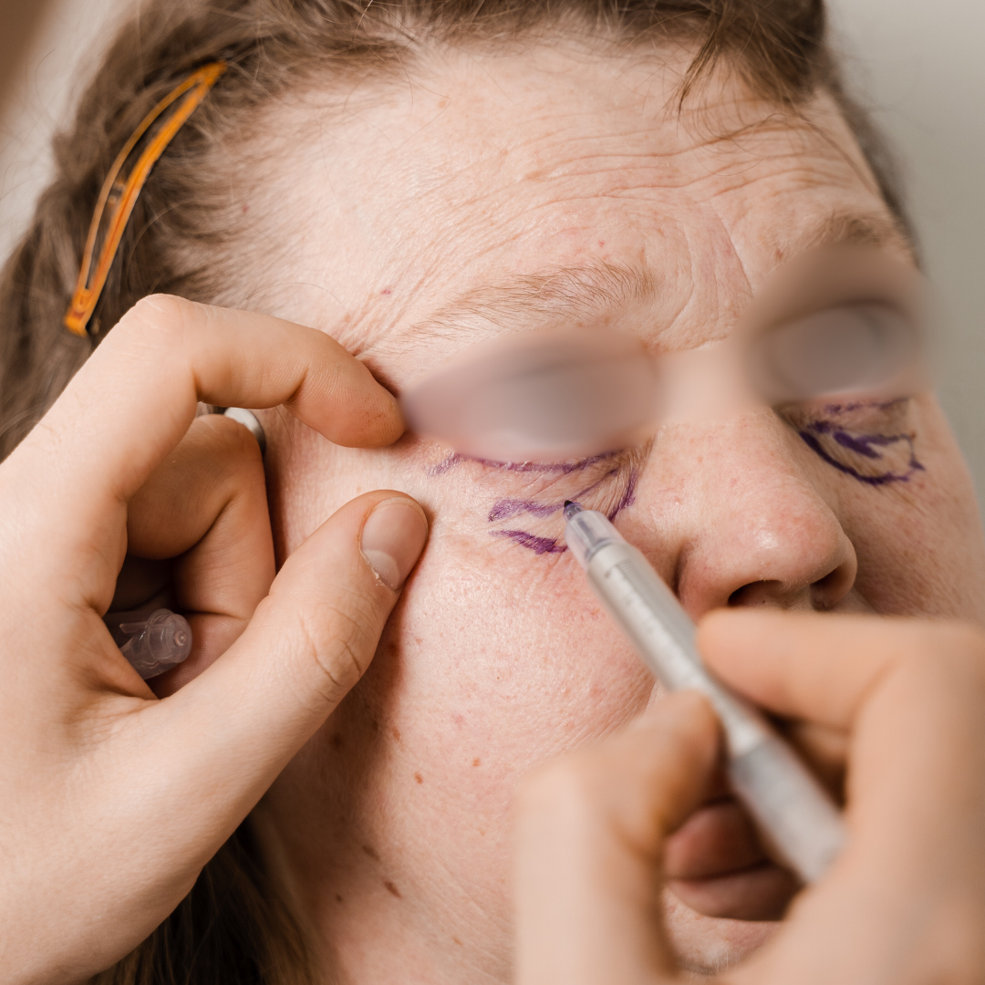 diseño de blefaroplastia inferior Dr. Esaud