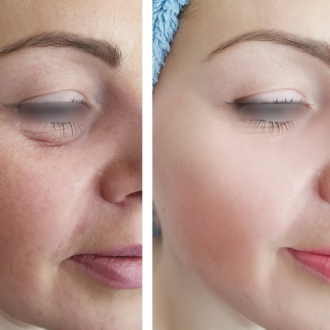 resultado de blefaroplastia mixta Dr. Esaud