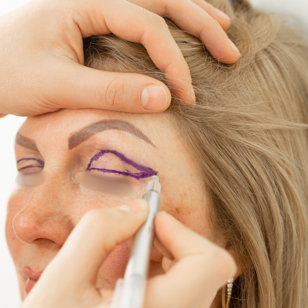 diseño de blefaroplastia superior Dr. Esaud