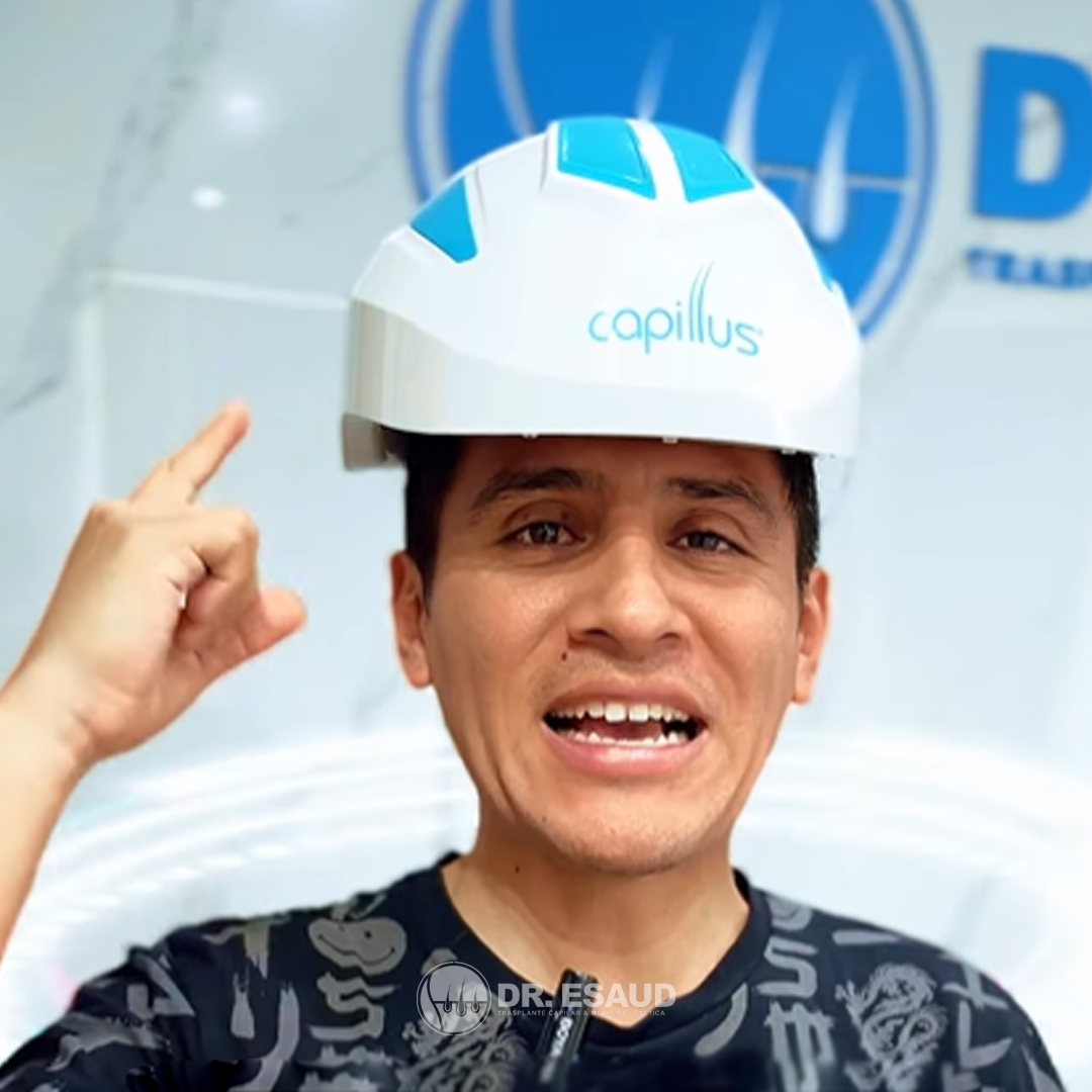 Gyofred Muñoz realizándose una mesoterapia capilar en Dr. Esaud