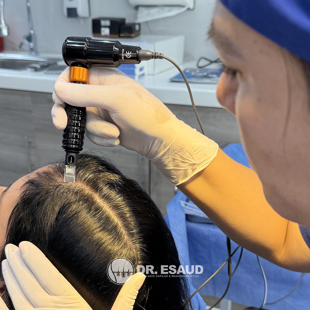 Paciente femenina realizándose MMP capilar para su alopecia en Dr. Esaud