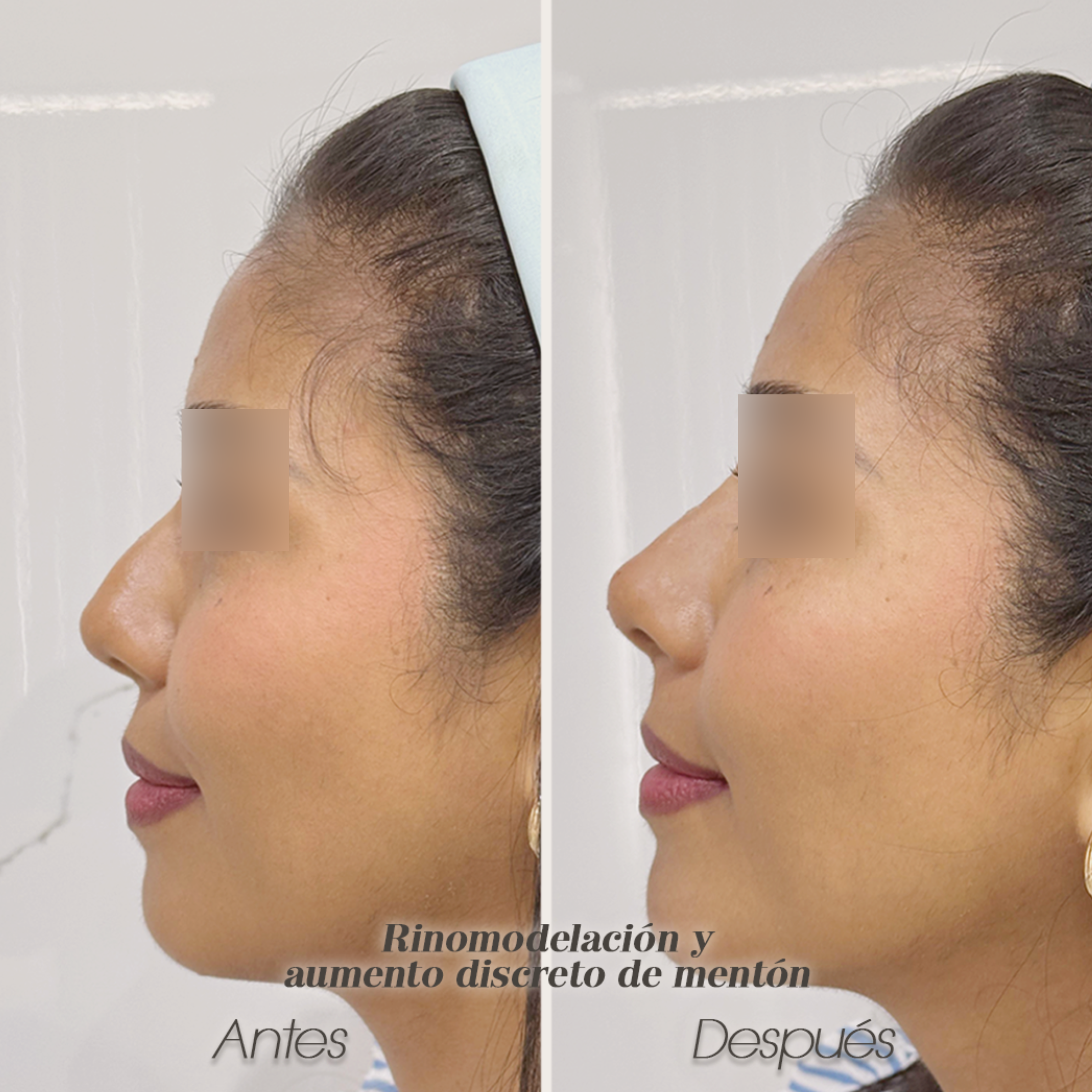 Resultado de una rinomodelación más aumento de mentón con ácido hialurónico realizado por el Dr. Esaud