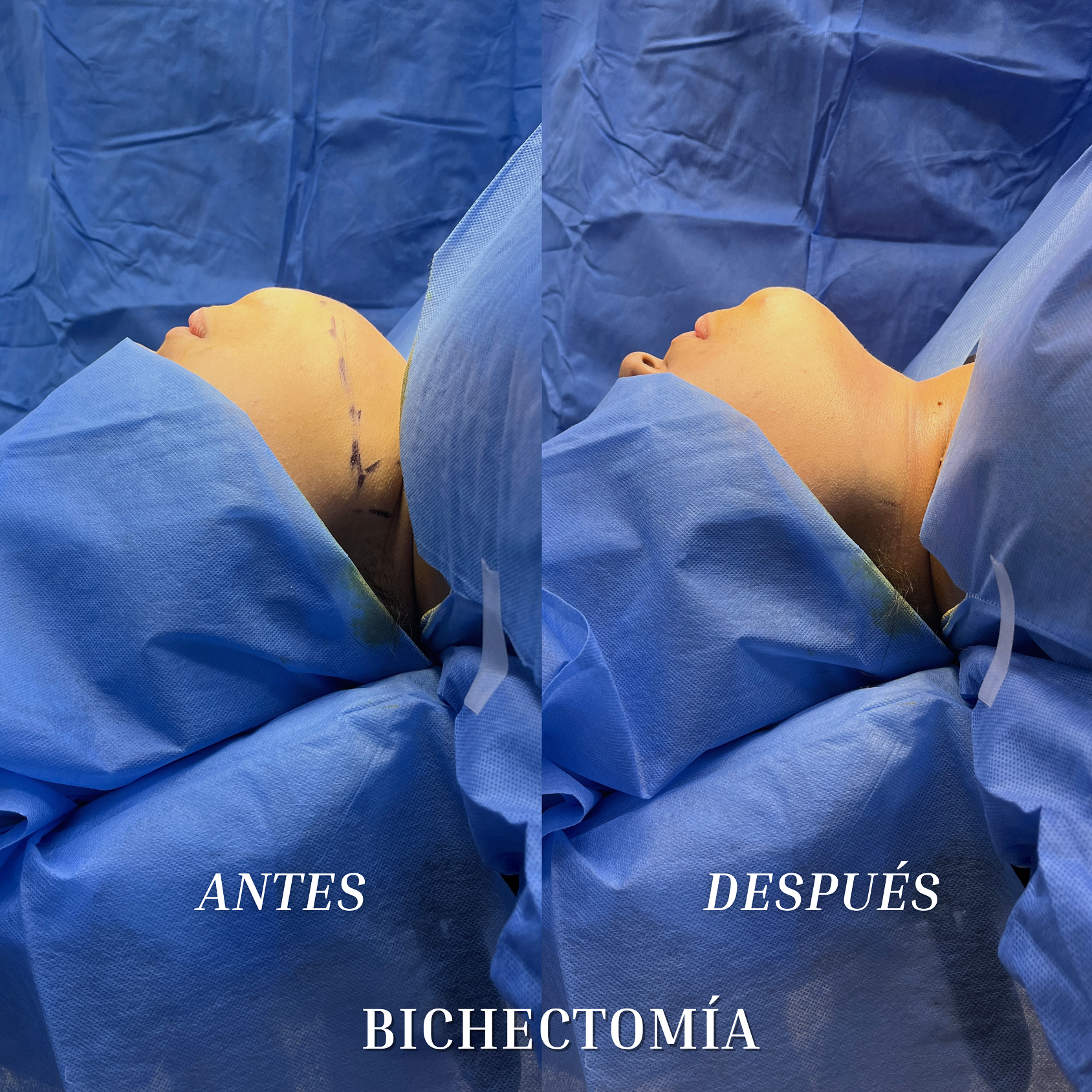Resultado de una bichectomía del Dr. Esaud