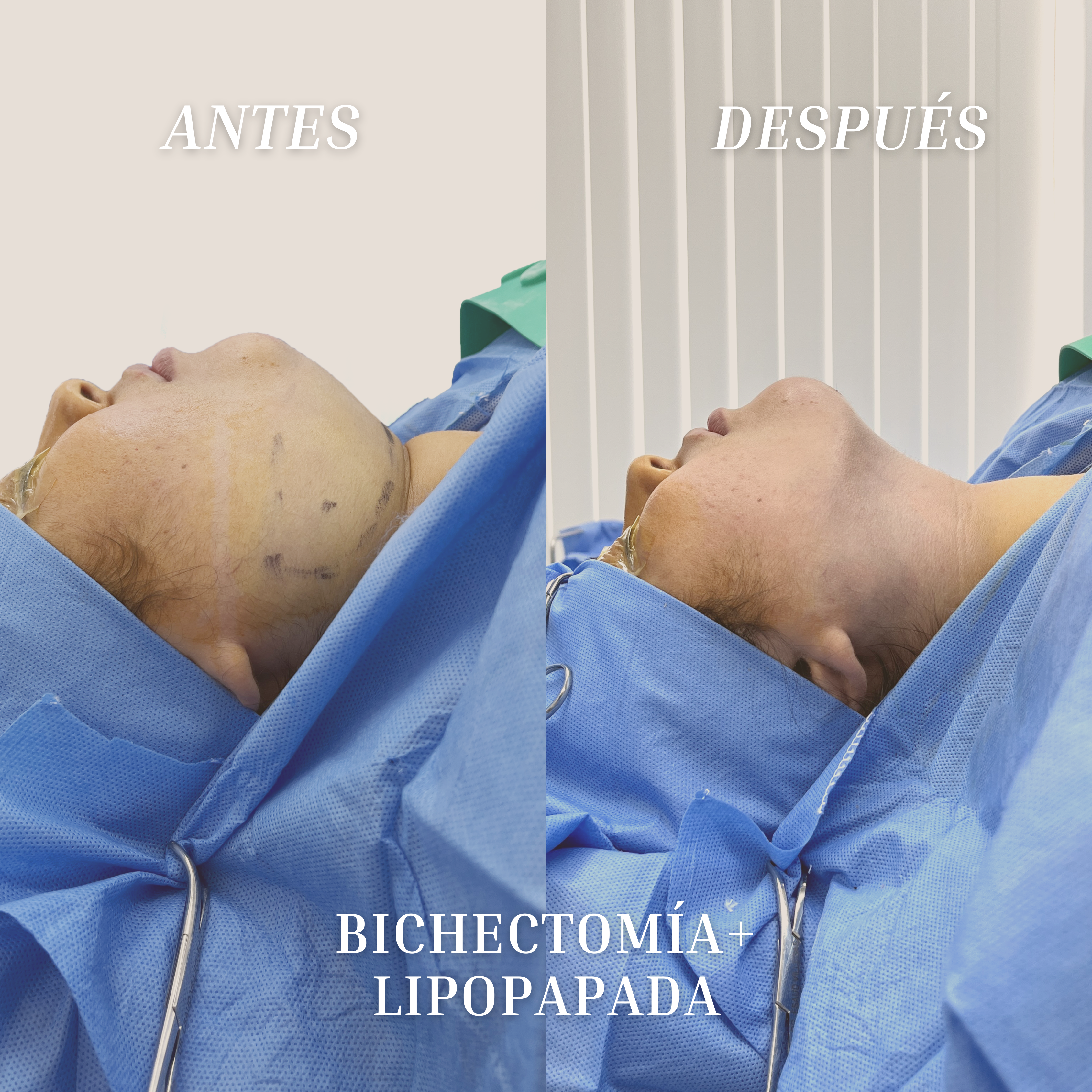Resultado de una bichectomía más lipopapada realizada por el Dr. Esaud