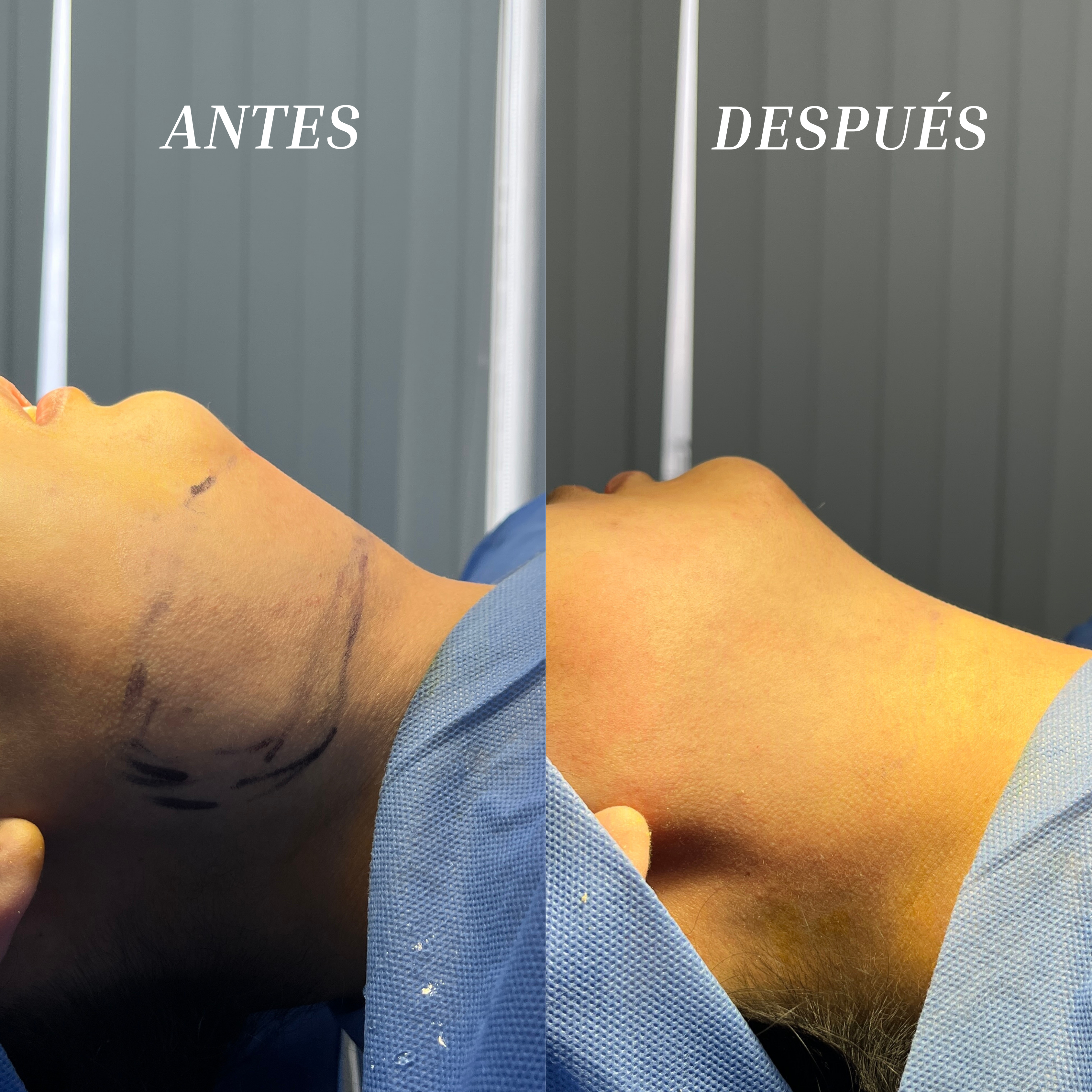 Resultado de una lipopapada realizada por el Dr. Esaud