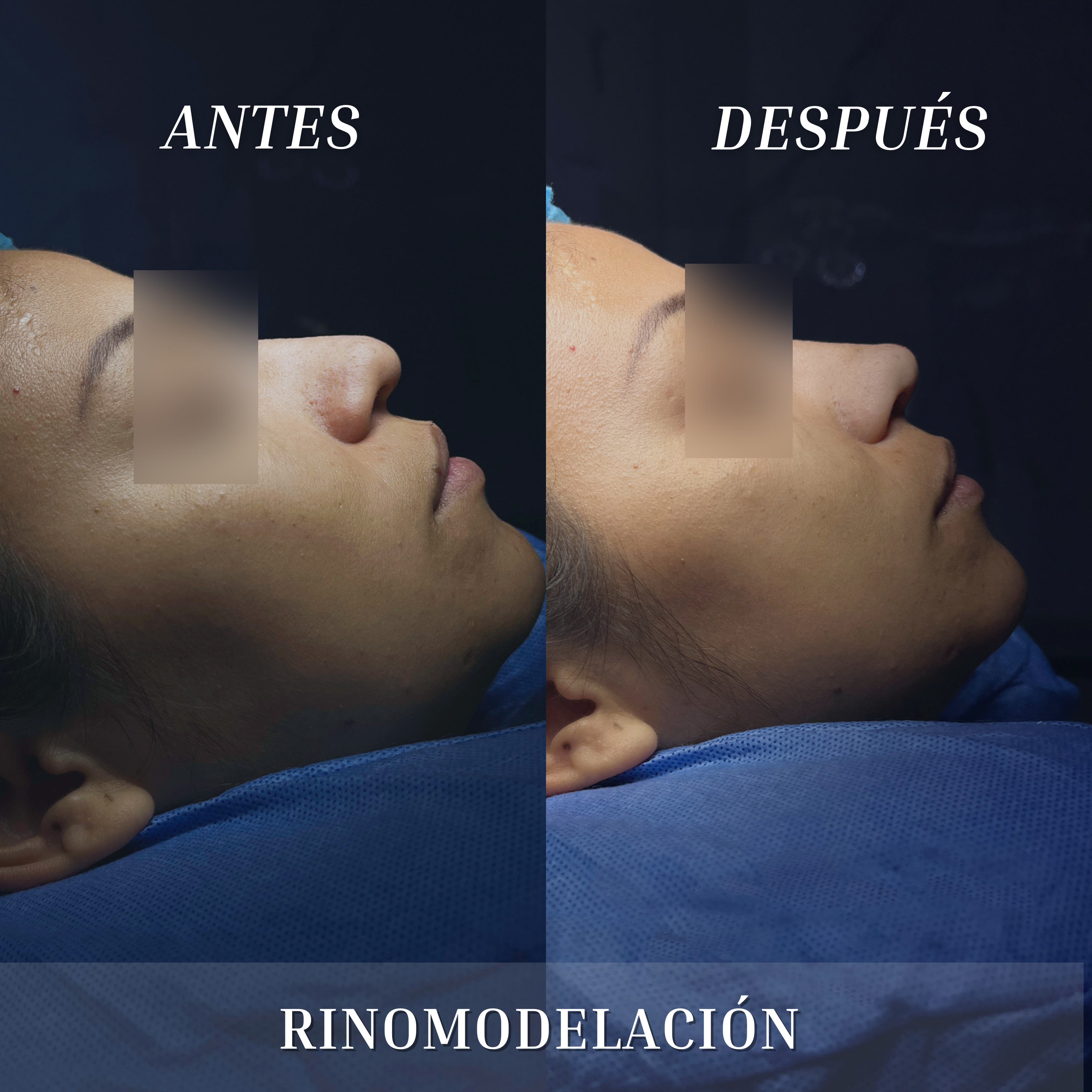 Resultado de una rinomodelación con ácido hialurónico realizada por el Dr. Esaud