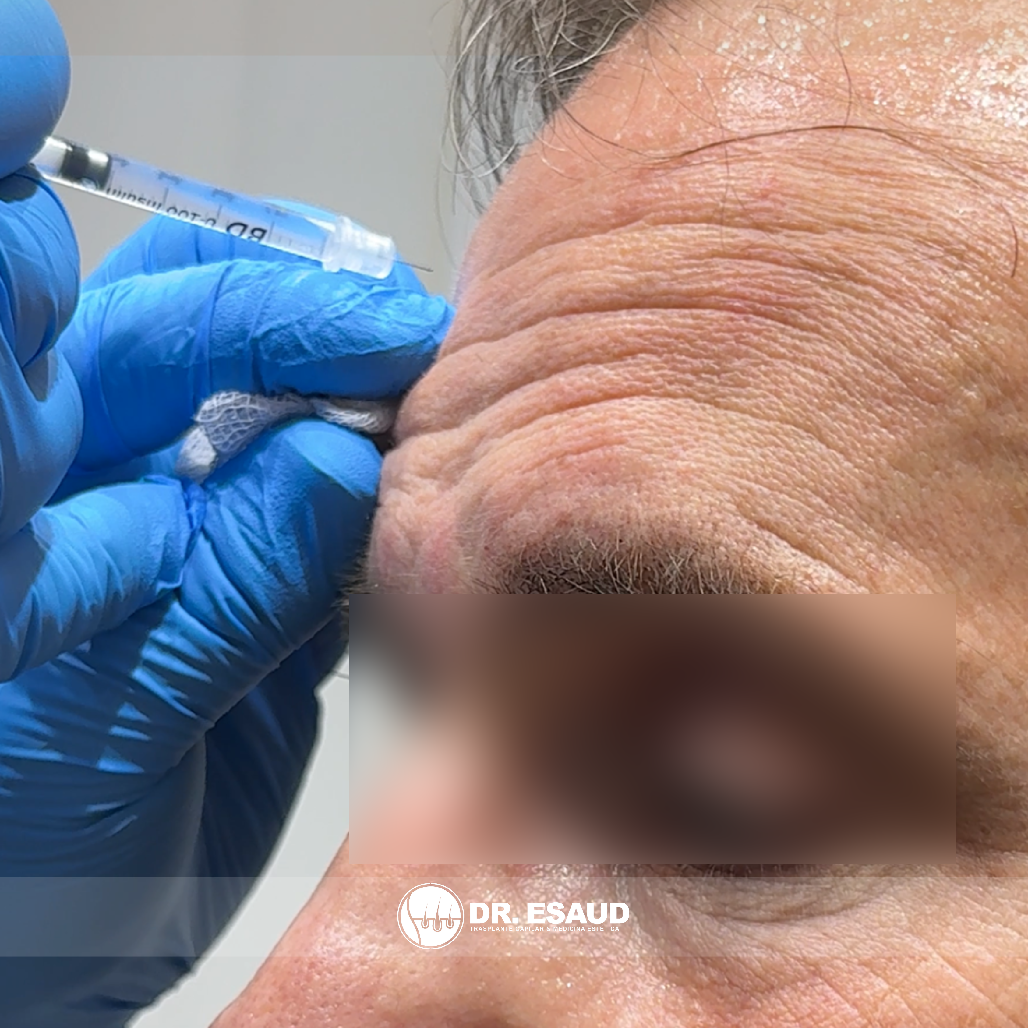 Aplicación de toxina botulínica (botox) en frente por el Dr. Esaud